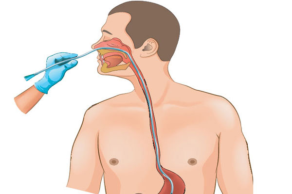 تعویض سوند بینی معده